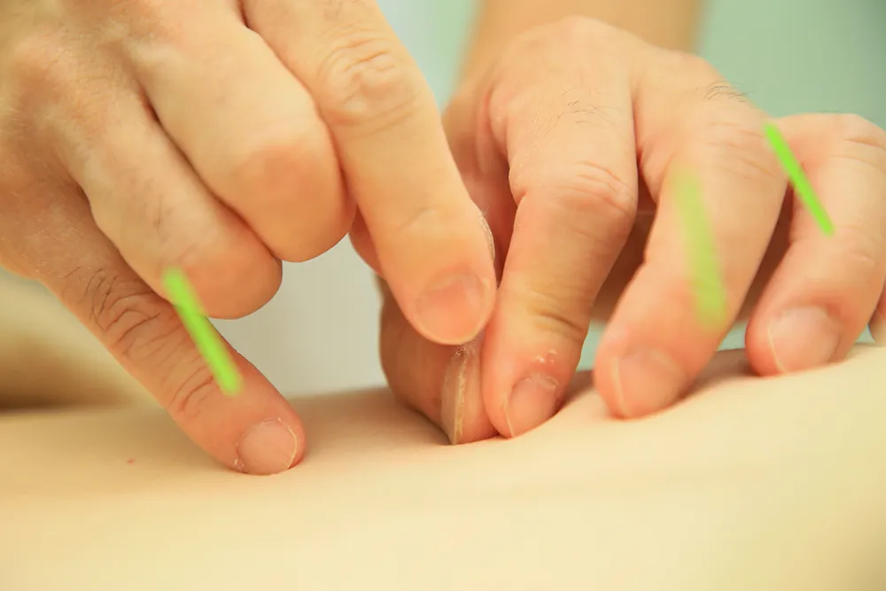 針灸施術：痛くない、熱くない針灸で症状を改善